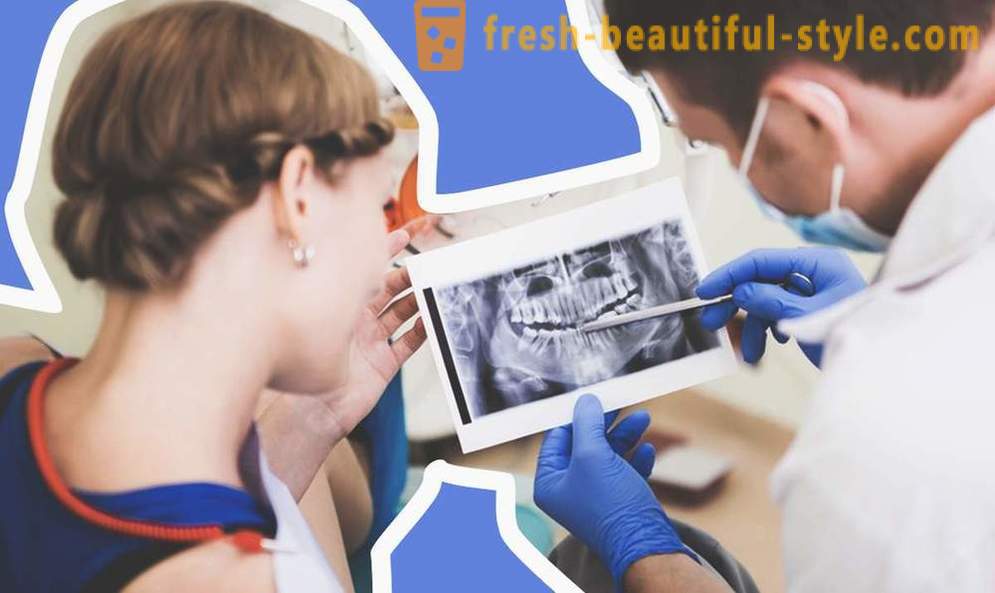 4 întrebări despre implanturi dentare