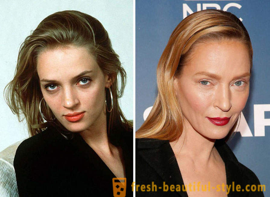 15 celebrități, terminat prost cu Botox