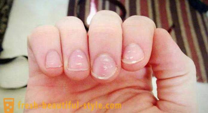 Pete albe pe unghiile degetelor: cauzele și tratamentul