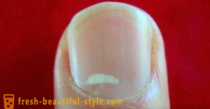 Pete albe pe unghiile degetelor: cauzele și tratamentul