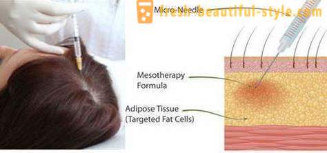 Mezoterapie pentru păr: instrumente de machiaj și contraindicații