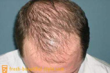 Cum de a accelera creșterea părului de pe cap? Restaurarea de creștere a părului